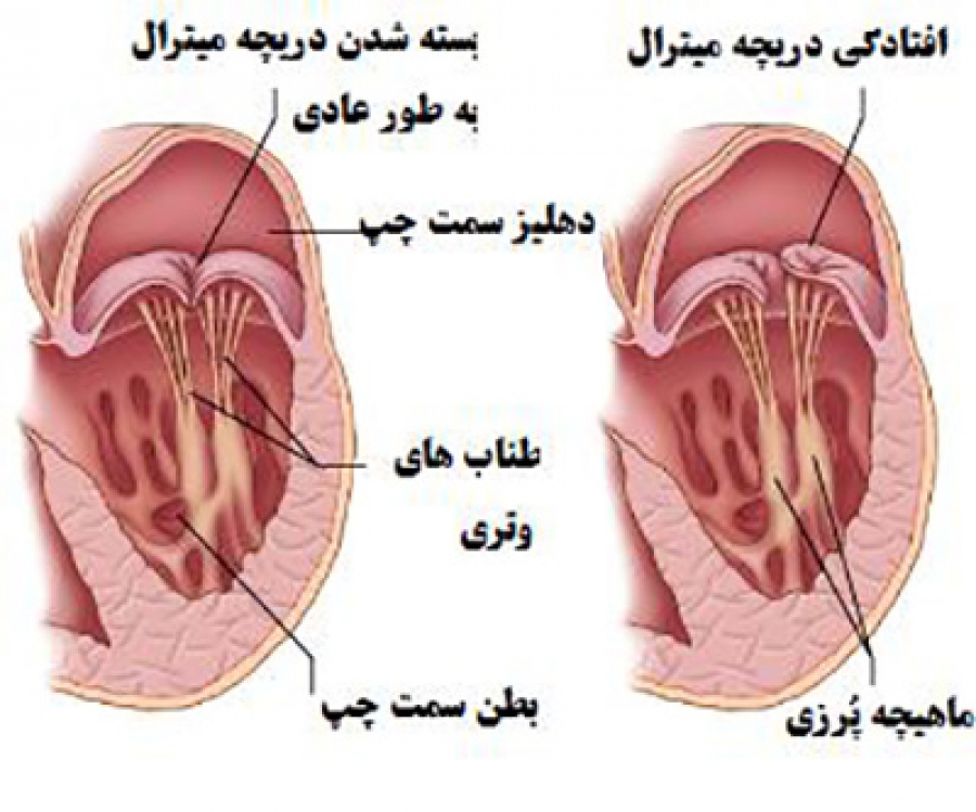 بیماری شایع قلبی در بین کودکان