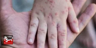 واکسیناسیون کودکان اتباع غیرایرانی علیه سرخک و فلج اطفال