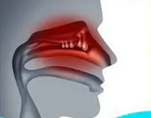 تحریک&zwnj;های مزمن مخاط بینی، منجر به ایجاد پولیپ می&zwnj;شود