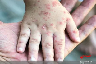 ضرورت واکسیناسیون کودکان لرستانی علیه بیماری سرخک