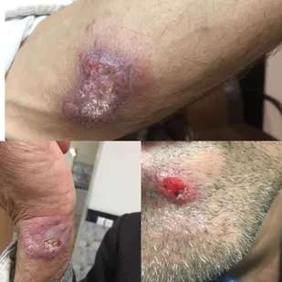 شناسایی اولین مورد ابتلا به سالک در پیشوا