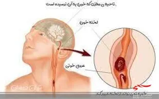 اختراع دستگاه هشداردهنده لخته خون به همت مخترع پارس&zwnj;آبادی