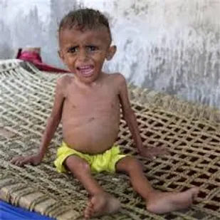 400 هزار کودک زیر 5 سال یمنی در آستانه مرگ از گرسنگی