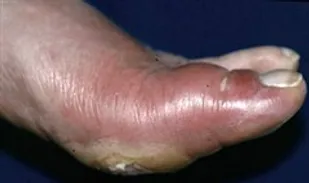 ساخت پماد سوختگی از گیاه عسلک
